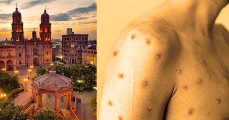 Se registran dos casos nuevos de viruela del mono en San Luis Potosí