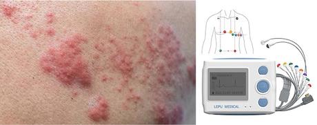 Vacuna contra el Holter Vacuna contra el Holter