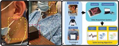 Dispositivo logra medir la actividad nerviosa para apoyar tratamientos Dispositivo logra medir la actividad nerviosa para apoyar tratamientos