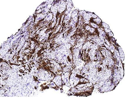 Melanoma amelanotico subungueal luego de un traumatismo