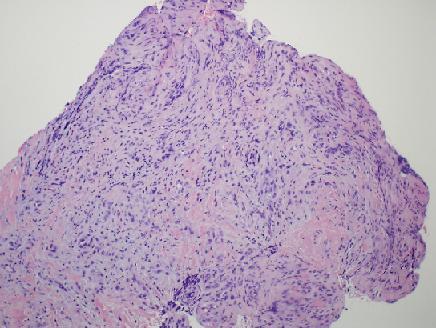 Melanoma amelanotico subungueal luego de un traumatismo