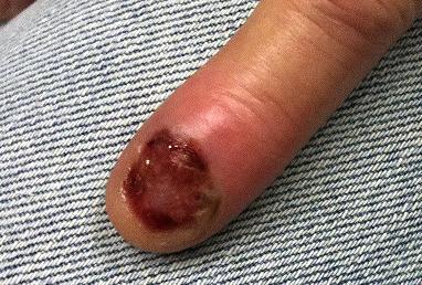 Melanoma amelanotico subungueal luego de un traumatismo