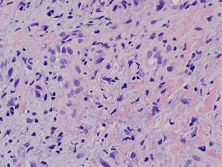 Melanoma amelanotico subungueal luego de un traumatismo