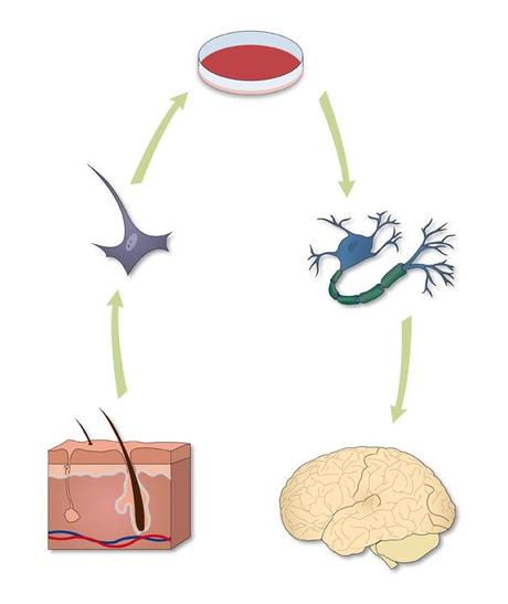 Vemos como con una célula extraída del tejido epitelial (fibroblasto) podemos conseguir, tras un proceso de ingeniería genética, una neurona funcional que puede ser utilizada en terapia celular para determinadas enfermedades neurodegenerativas