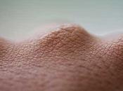 Epidermólisis ampollar simple