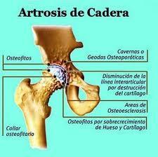 Síntomas de la artrosis de cadera