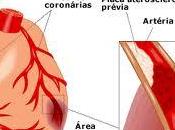 Infarto miocardio