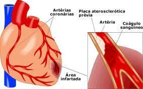infartomiocardio Infarto de miocardio