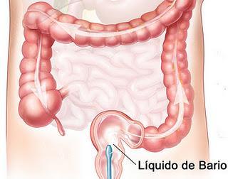 Enema opaco Enema opaco