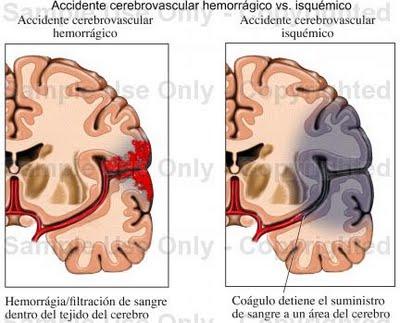 La circulación colateral en el accidente cerebrovascular agudo
