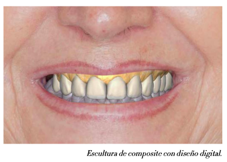 SONRISA RADIANTE EN UN SOLO DÍA - BLANQUEAMIENTO Y MICROCARILLAS