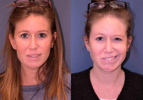 que es la paralisis facial