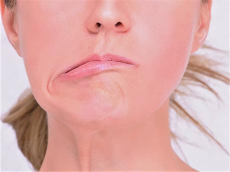 causas parálisis facial