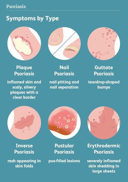 QUÉ ES LA PSORIASIS?!. TODO LO QUE NECESITAS SABER