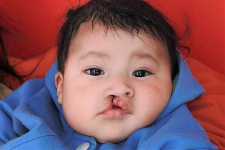 que es el labio leporino