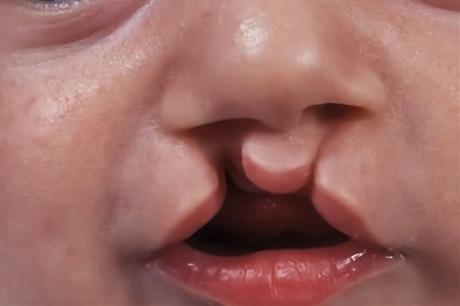 definicion labio leporino