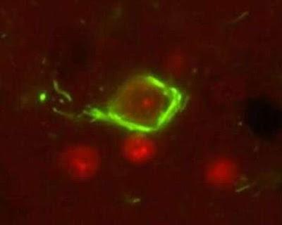 Investigan otra diana terapéutica para la enfermedad de Alzheimer