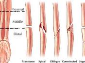 Fracturas