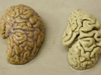 Hemisferio de un cerebro sano (a la izquierda) y atacado por Alzheimer (a la derecha). Foto del Hospital de la universidad de Chêne-Bourg, Suiza