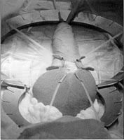 El Implante de Pene es lo Mejor para la Disfuncion Erectil