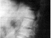 Venezolanas Presentan Fracturas Vertebrales