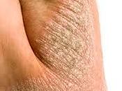 Conocer psoriasis