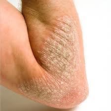 psoriais Conocer la psoriasis