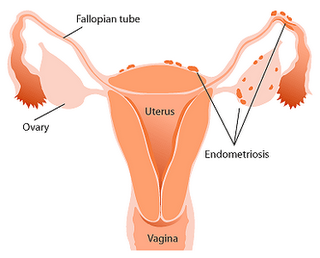 Conocer algo mejor la ENDOMETRIOSIS