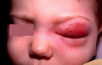 Haemophilus Influenzae tipo b (Hib)