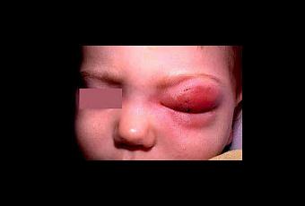 haemophilus influenzae tipo b que es