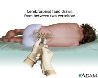 Más sobre el Haemophilus influenza tipo b (Hib)