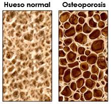 La osteoporosis