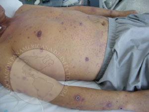 El paciente neutropénico y febril, ¿qué hacer?