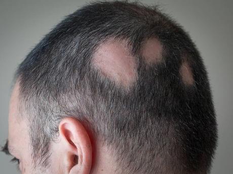 El fármaco que está revolucionando la calvicie inmunológica