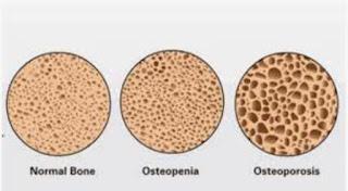 Programa de entrenamiento para  personas de 50 años con osteopenia