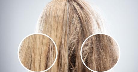 ¿Qué es la taninoplastia? ¿Qué es la taninoplastia?