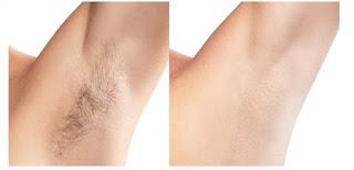 Depilación sin dolor, una alternativa que previene infecciones y manchas en la piel Depilación sin dolor, una alternativa que previene infecciones y manchas en la piel