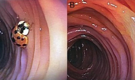 #SALUD: Hombre descubre que tiene una #SALUD: Hombre descubre tiene