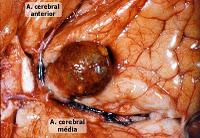 Tratamiento no Quirurgico de los Aneurismas Cerebrales