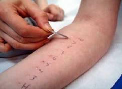 Reacciones alérgicas