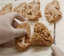 El banco de Salamanca ya reúne seis donaciones de cerebro para investigación