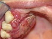 Pese programa preventivo Cuba, aumenta cáncer bucal