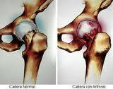 Diferencias entre Artritis y Artrosis