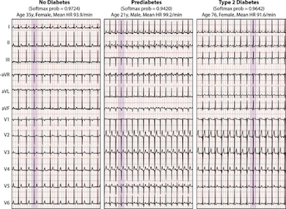 Machine learning + electrocardiograma pueden predecir la diabetes y la prediabetes Machine learning + electrocardiograma pueden predecir la diabetes y la prediabetes
