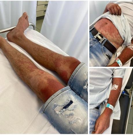 nolotil graves daños