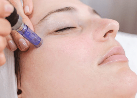 Microneedling Microneedling