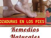 Trucos para evitar rozaduras pies curarlas remedios naturales