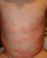 La urticaria