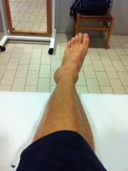 Una lesión habitual: el esguince de tobillo