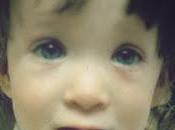 alcohol, devastador durante embarazo. Miren cara estos niños